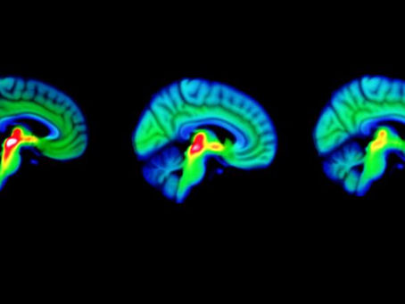 Study reveals roots of Parkinson's in the brain