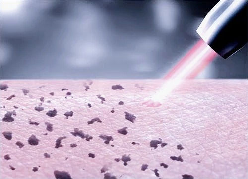 pico laser before and after