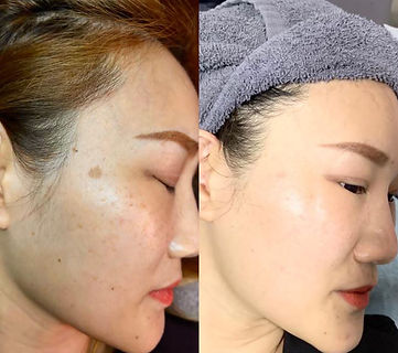 pico laser treatment before and after