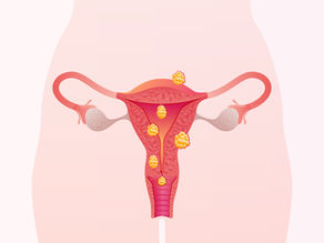 Miomas uterinos sempre causam infertilidade?