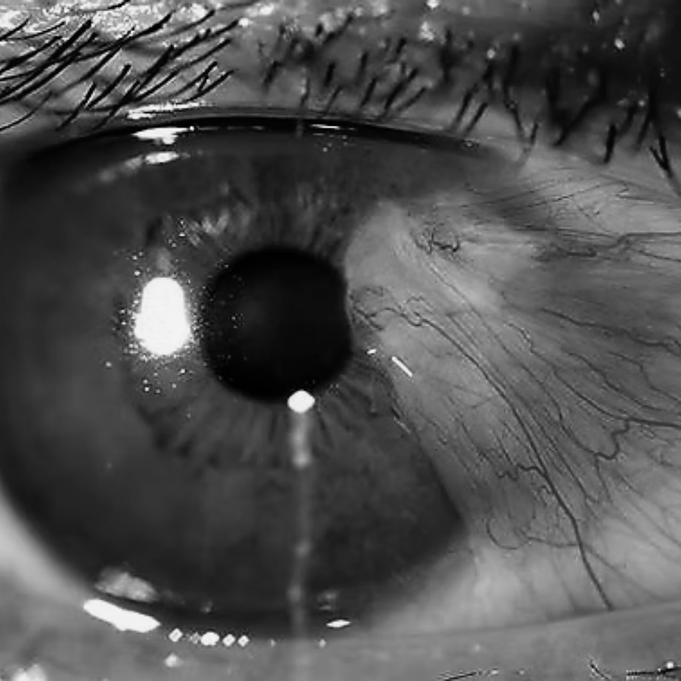 pterygium.png