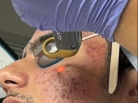 How Should Acne Be Treated? A Guide to Breakouts, Inflammation, Pigmentation and Skin Type