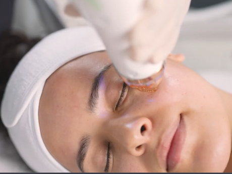 RF Microneedling Birmingham: Cutera Secret PRO for Firmer, Smoother-Looking Skin