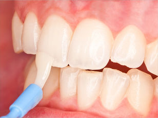 Say Goodbye to Cavities with Fluoride Treatment at Tricity Smiles in Chandigarh