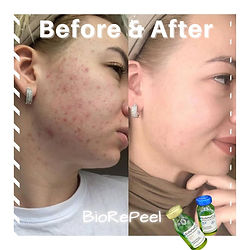 6 BioRePeel + Dermaplane