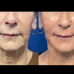 3 BioRePeel + Dermaplane
