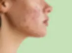 (PCOS) 2.webp
