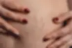 Stretch Marks 4.webp