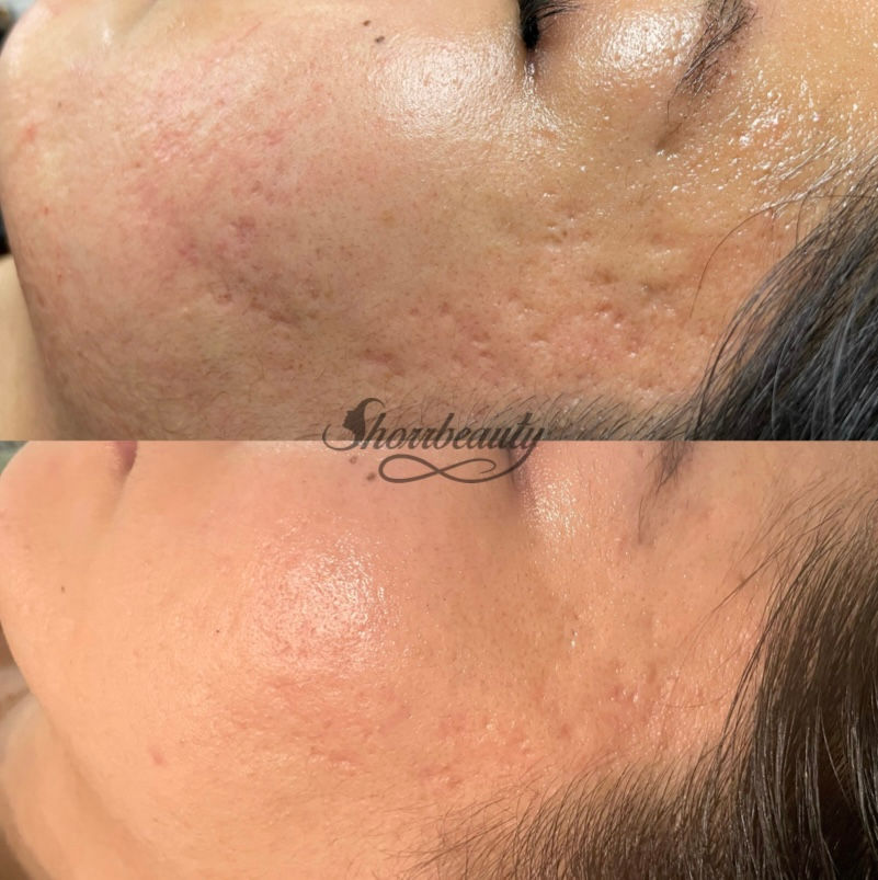 Acne scars