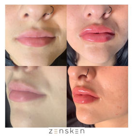 Lip Fillers - Before and After