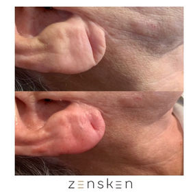Ear with Dermal Fillers - Before and After
