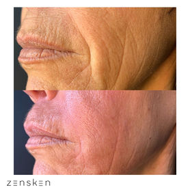 Nasal - Dermal Fillers Before and After