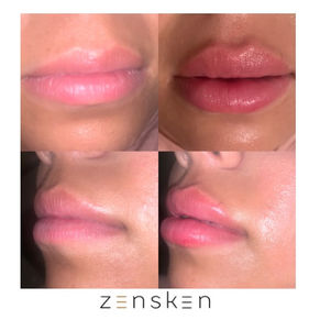 Lip Fillers Before and After