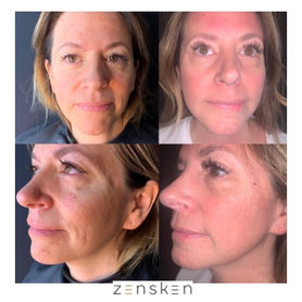 Belafill Before and After
