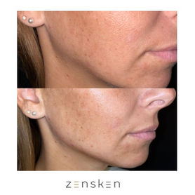 Jawline with Dermal Fillers - Before and After