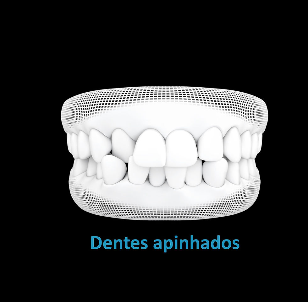 Dentes apinhados