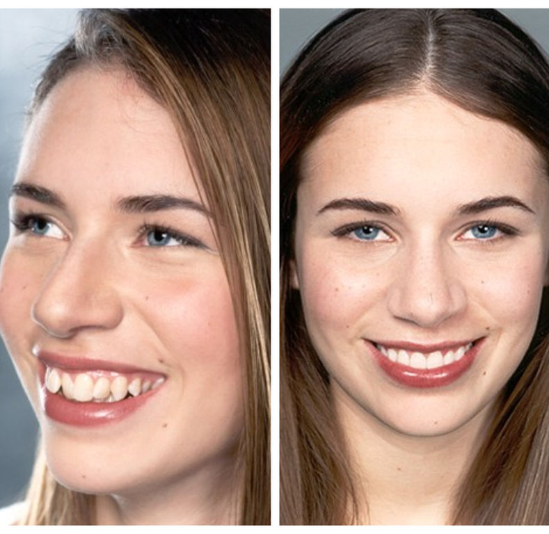 Before and after dental veneers for patient in Shelby Township MI