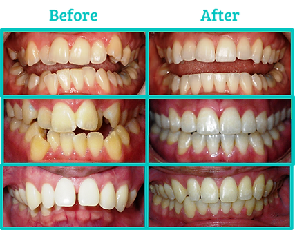 SureSmile Dental Aligners