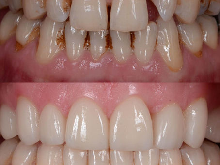 The Magic of Dental Veneers