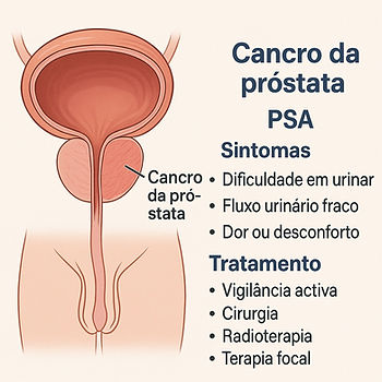 Ilustração médica do cancro da próstatacom destaque para os sintomas e opções de tratamento