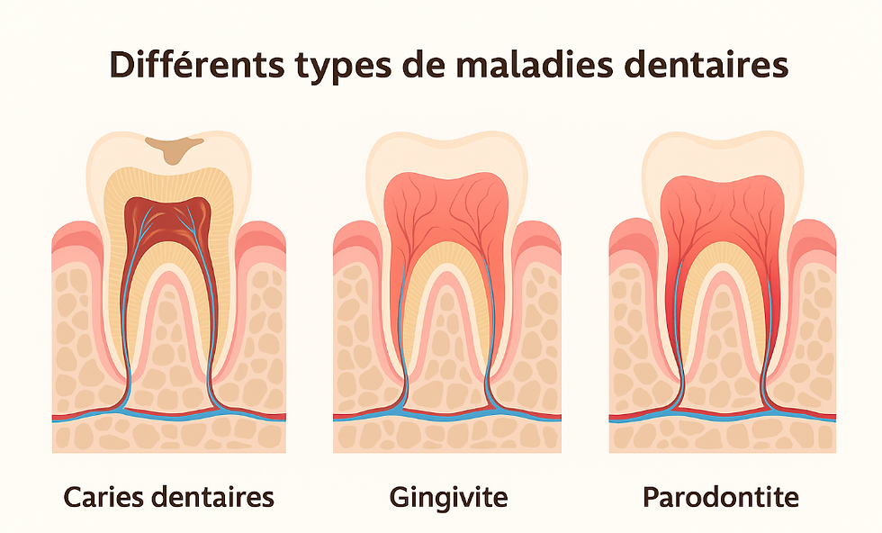 Schéma comparatif montrant les caries dentaires, la gingivite et la parodontite, avec l’évolution visible des tissus affectés.