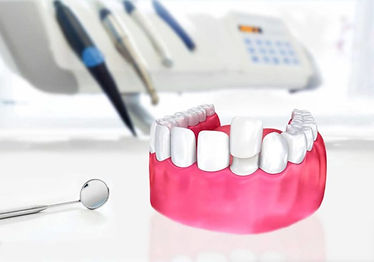facettes dentaires au dentiste dentora