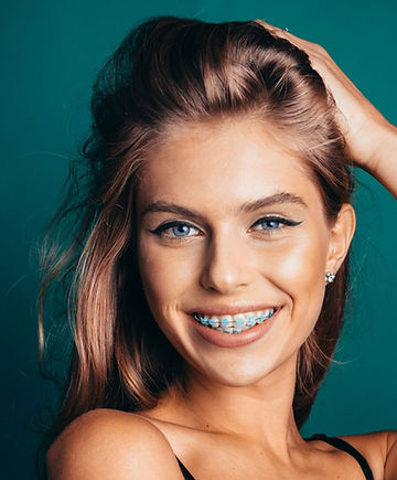 Femme avec appareil dentaire à bagues – orthodontie classique à Saint Denis