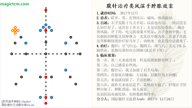 No.36 类风湿手肿胀(Rheumatoid Arthritis --Swelling Hand)