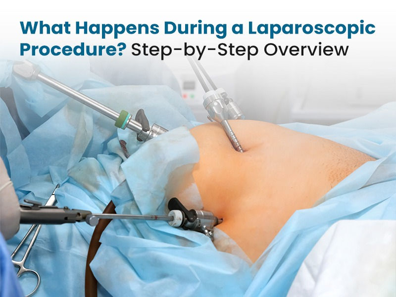 What Happens During a Laparoscopic Surgery Procedure? Step-by-Step Overview