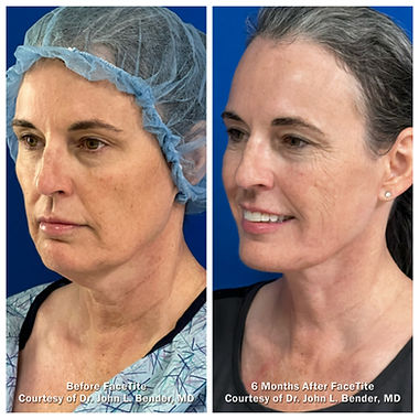 FaceTite 5 before and after results Miramont MedSpa