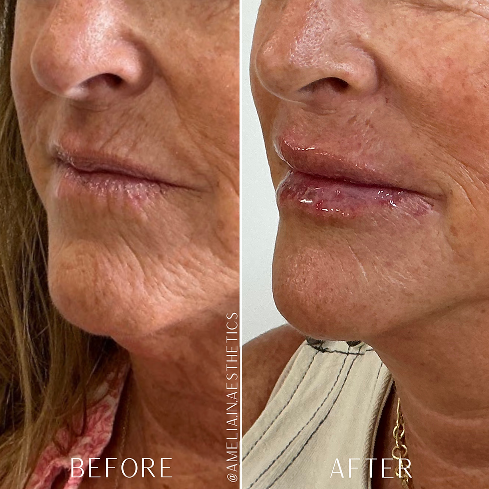 raleigh-perioral-filler-skin-quality-before-after-carolina-aesthetic-collective.png