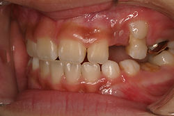 MRC及び矯正症例