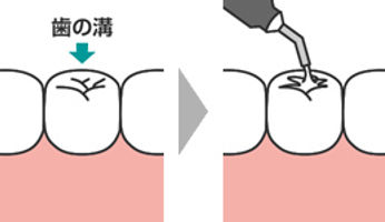 フィッシャーシーラント