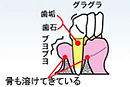 歯周病中期（中程度歯周炎）イラスト