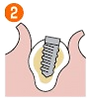 インプラント埋込手術
