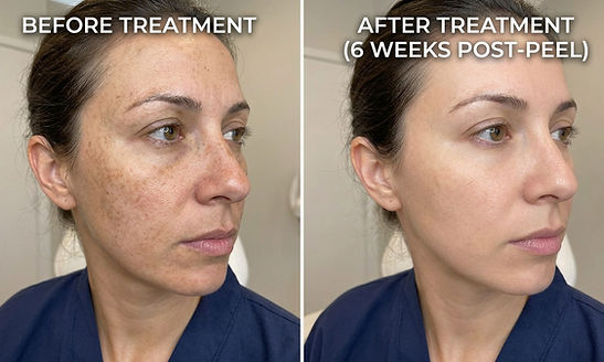 Chemical Peel Facials 5.jpeg