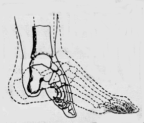healthy foot anatomy versus foot binding deformation