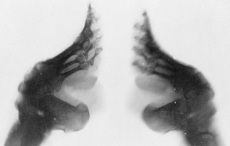 X-ray of Lotus feet from foot binding