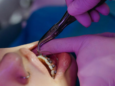 Vous souhaitez corriger un problème d'alignement ? Les soins d'orthodontie à Schifflange
