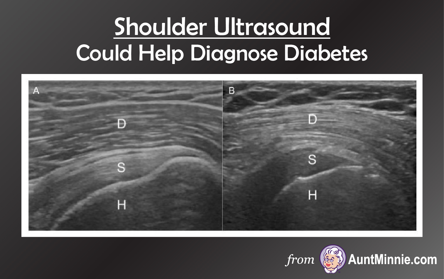 Shoulder Ultrasound Could Help Diagnose Diabetes Medical XRay