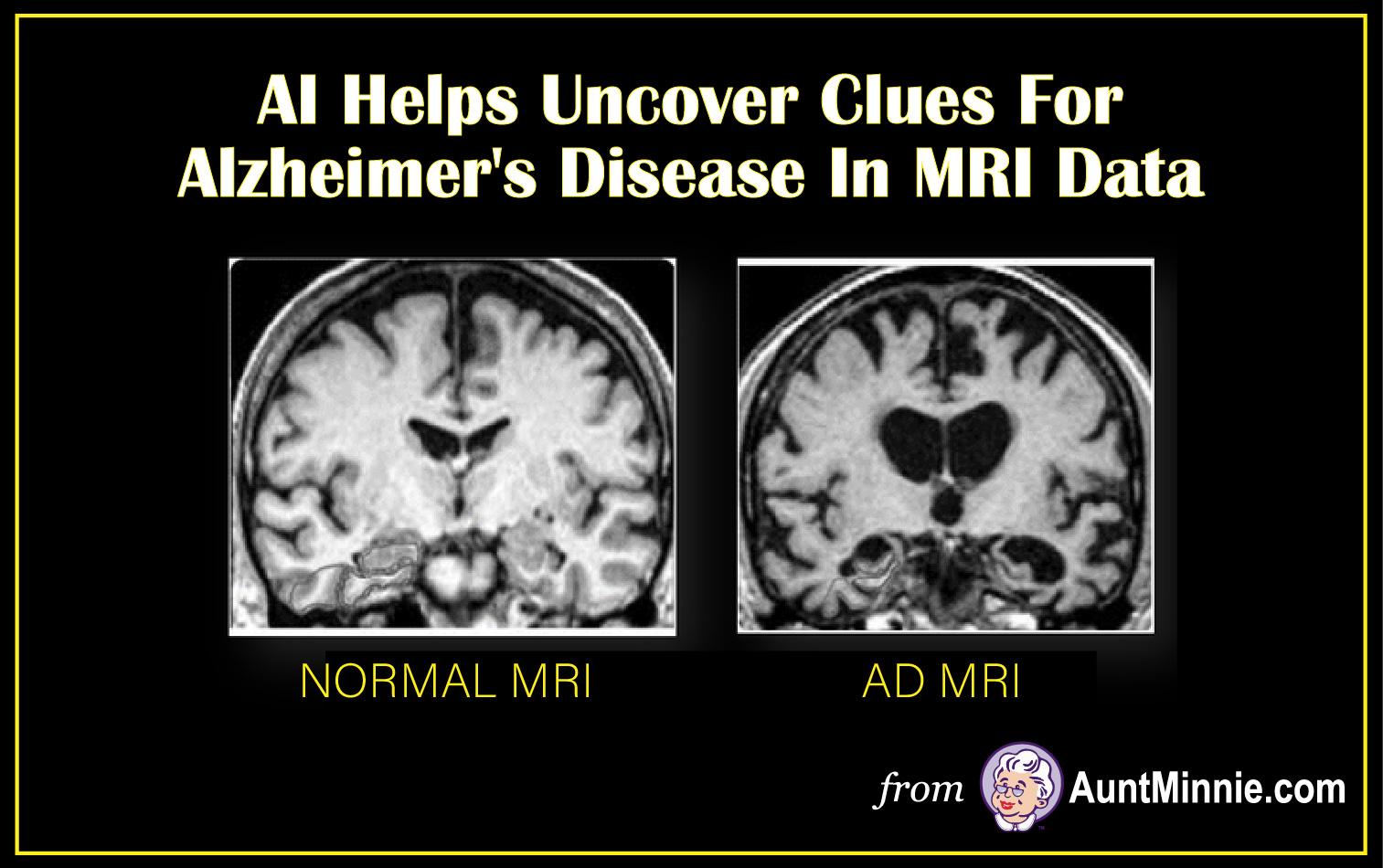 AI Helps Uncover Clues For Alzheimer's Disease In MRI Data Medical X