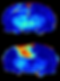 Blood perfusion to a glioma