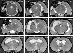 MRI sequence of glioma
