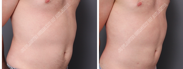 LIPOSUCTION Before & After