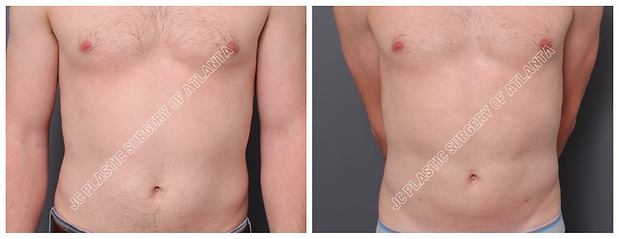 LIPOSUCTION Before & After