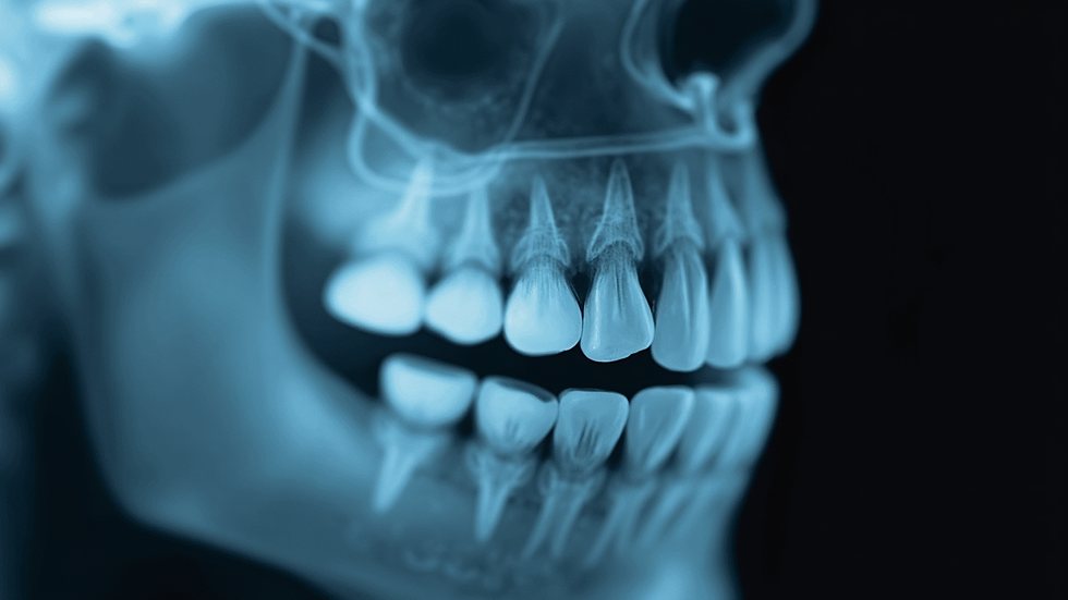 Vista lateral de radiografia mostrando dentes sisos inclusos