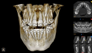 82003D_12x10_Impactedcanines_Brackets_MAR_1.jpg