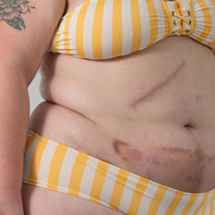 séance de photothérapie réalisée par Bertrand Perret pour mieux accepter son corps et l'obésité. gros plan sur les cicatrice de la chirurgie bariatrique