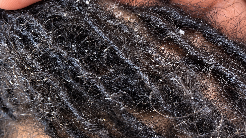 Visible flakes and product buildup between natural hair twists