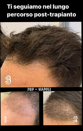 PRP Post Trapianto Capelli